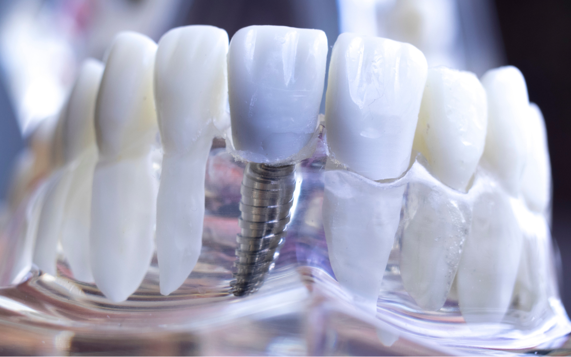 Implantodontia: Restaurando Sorrisos com Implantes