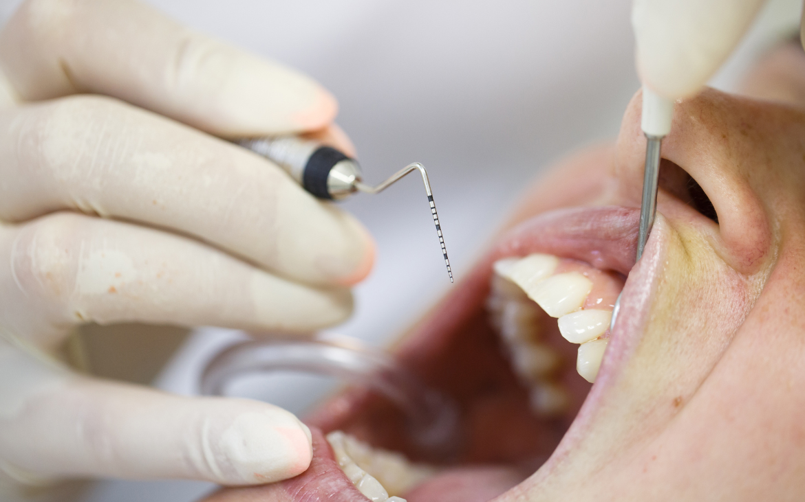 Periodontia: Cuidando da Saúde das Gengivas