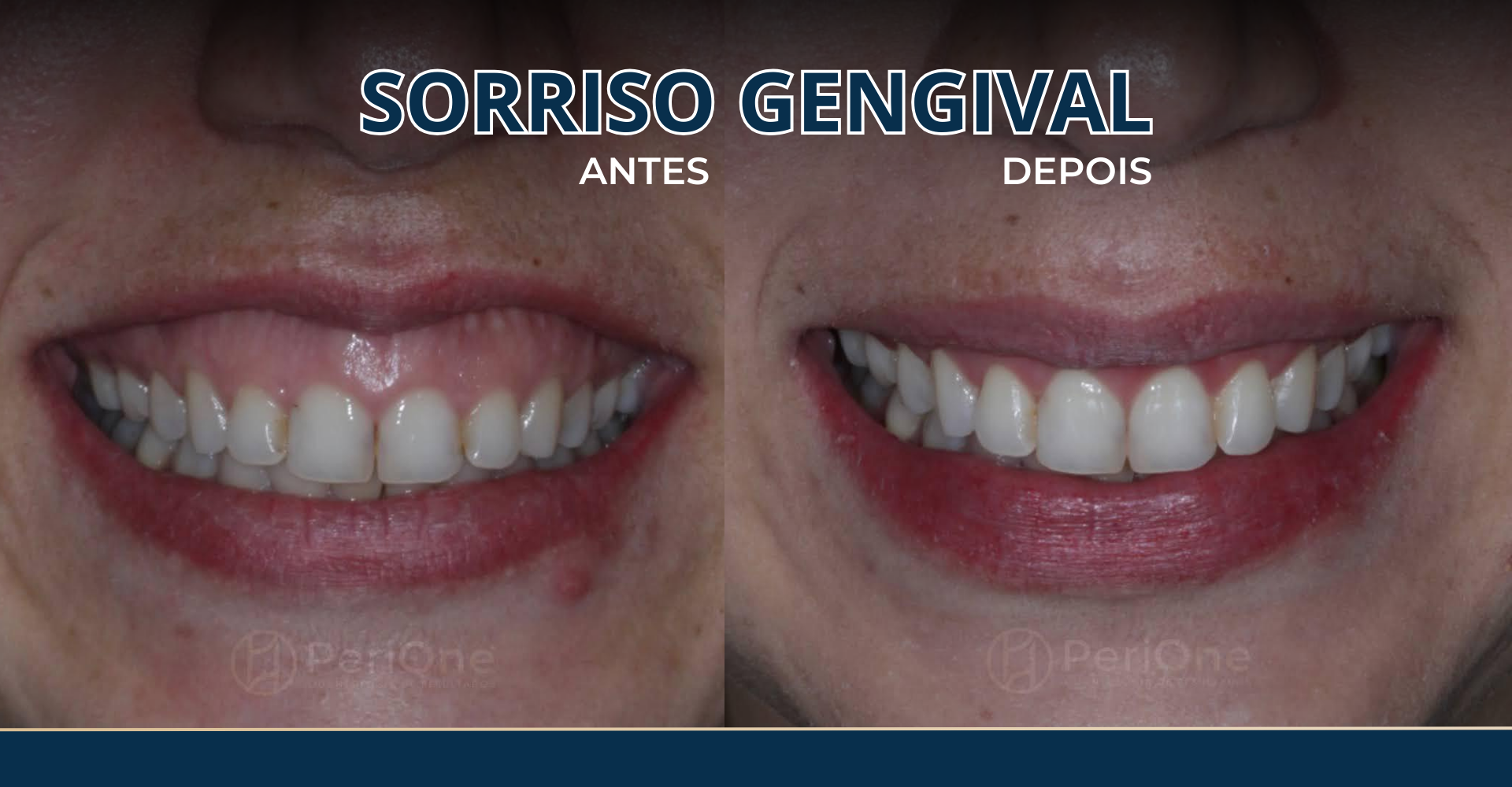 Sorriso gengival