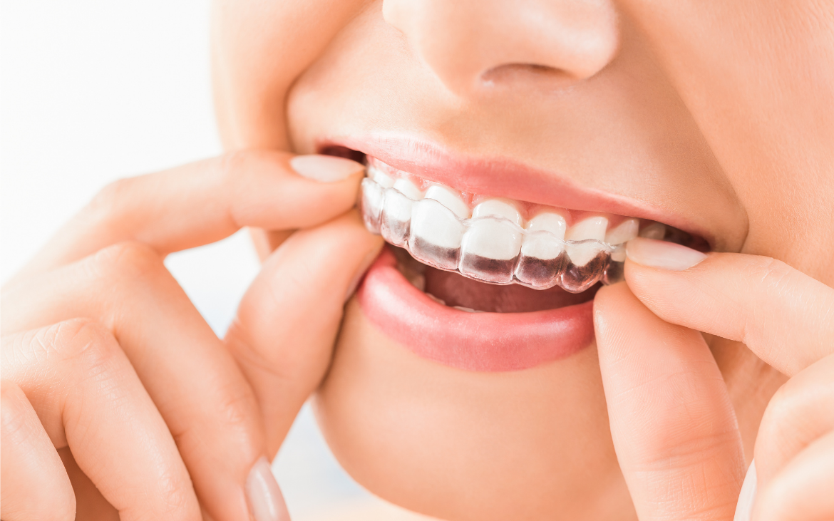 Ortodontia: Sorrisos Alinhados com Tecnologia e Precisão – Ortodontia Convencional e Invisalign